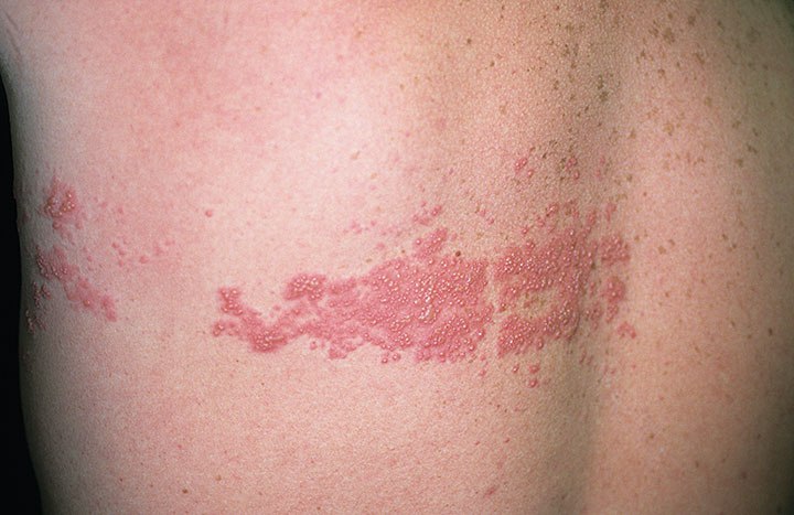 culebrilla